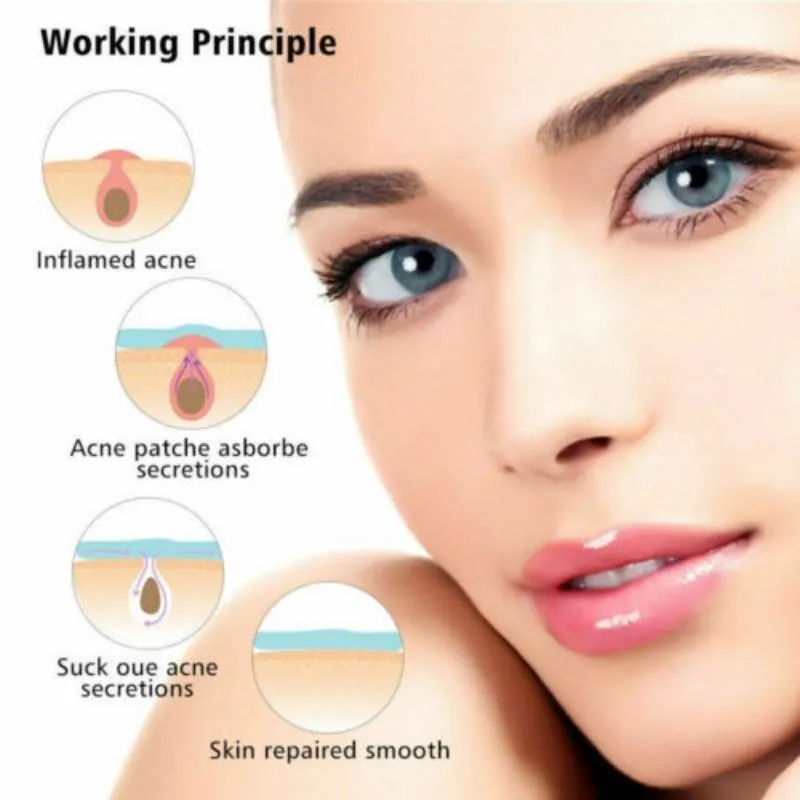 3-piece Acne Treatment Set for Scars and Pimples